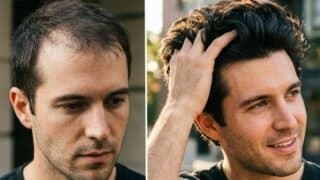 Before and after thicker hair results for men