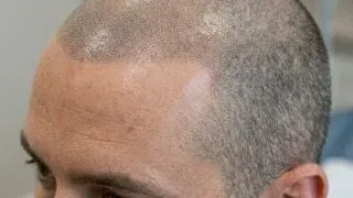 Scalp micropigmentation results